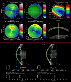 GL_ANT_Cornea_Analysis_biometry_300